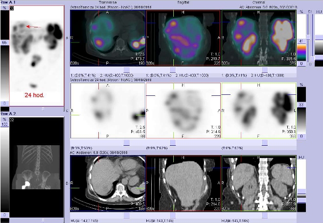 Obr. č. 5: Fúze obrazů SPECT a CT. Zaměřeno na ložisko v pravém jaterním laloku. Vyšetření 24 hod. po aplikaci OctreoScanu.