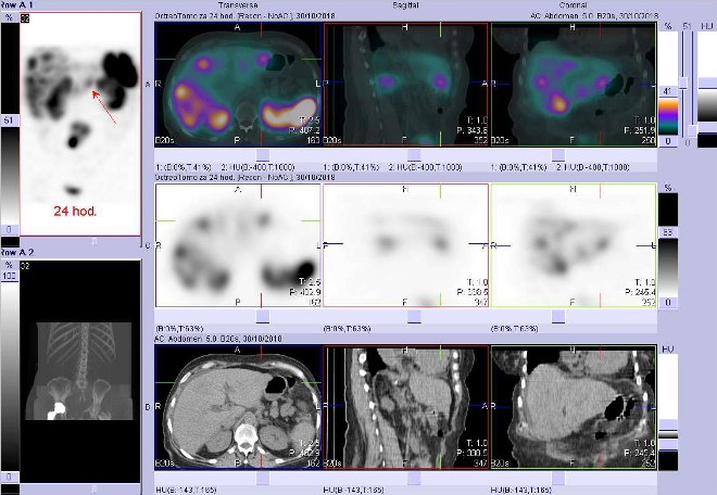 Obr. č. 7: Fúze obrazů SPECT a CT. Zaměřeno na ložisko v levém jaterním laloku. Vyšetření 24 hod. po aplikaci OctreoScanu.