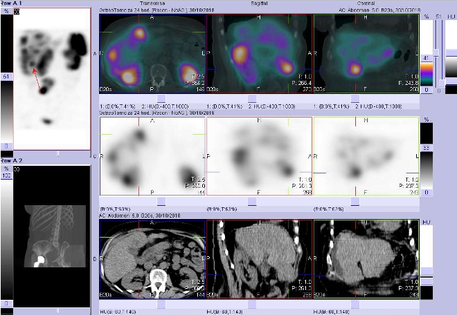Obr. č. 8: Fúze obrazů SPECT a CT. Zaměřeno na ložisko v pravém jaterním laloku. Vyšetření 24 hod. po aplikaci OctreoScanu.