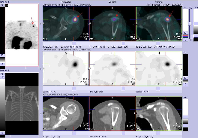 Obr. č. 1: Fúze obrazů SPECT a CT.  Zaměřeno na ložisko v proximální části levého humeru. Vyšetření 24 hod. po aplikaci OctreoScanu.