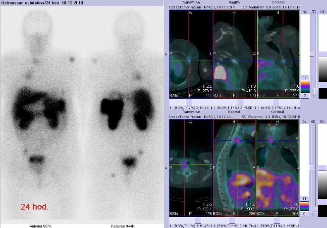 Obr. č. 4: Celotělová scintigrafie v přední a zadní projekci a fúze obrazů SPECT a CT. Zaměřeno na ložisko v jednom levostranném žebru ventrolaterálně a ložisko v pravém laloku štítné žlázy. Vyšetření 24 hod. po aplikaci OctreoScanu.
