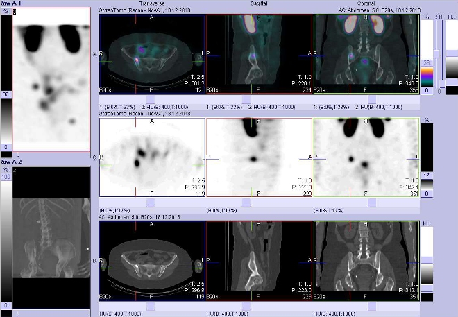 Obr. č. 7: Fúze obrazů SPECT a CT.  Zaměřeno na ložisko v lopatě kosti kyčelní vpravo. Vyšetření 24 hod. po aplikaci OctreoScanu.