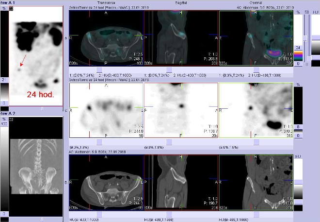 Obr. č. 10: Fúze obrazů SPECT a CT. Vyšetření 24 hod. po aplikaci radioindikátoru. Zaměřeno na ložisko v kosti kyčelní vpravo.