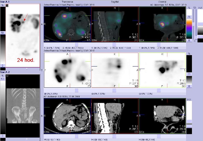 Obr. č. 11: Fúze obrazů SPECT a CT. Vyšetření 24 hod. po aplikaci radioindikátoru. Zaměřeno na ložisko v levém jaterním laloku.