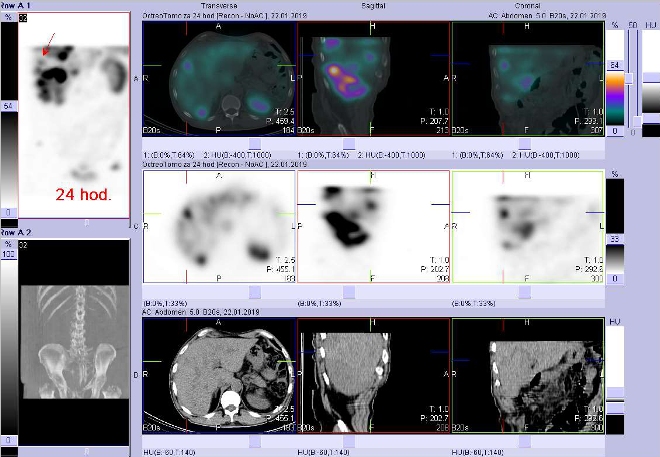 Obr. č. 12: Fúze obrazů SPECT a CT. Vyšetření 24 hod. po aplikaci radioindikátoru. Zaměřeno na ložisko v pravém jaterním laloku.