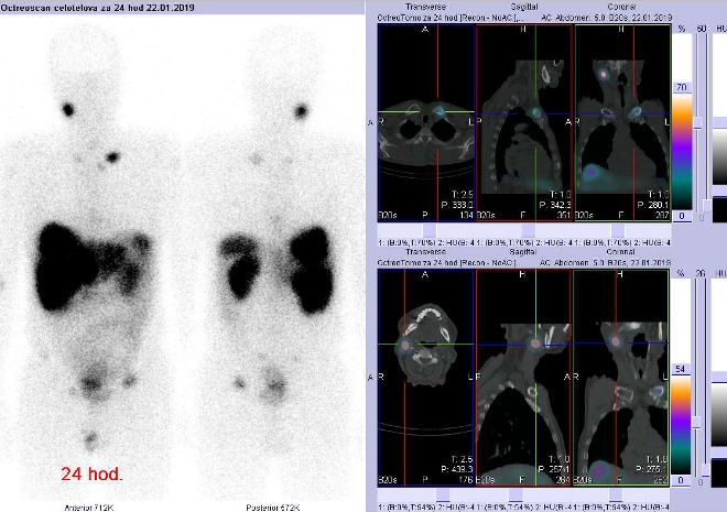 Obr.3: Celotělová scintigrafie a fúze obrazů SPECT a CT. Vyšetření 24 hod. po aplikaci radioindikátoru. Zaměřeno na ložisko v levé klíční kosti v blízkosti sternoklavikulárního skloubení a na uzlinu vpravo na krku.