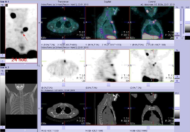 Obr. č. 4: Fúze obrazů SPECT a CT. Vyšetření 24 hod. po aplikaci radioindikátoru. Zaměřeno na ložisko v levém sternoklavikulárním skloubení.