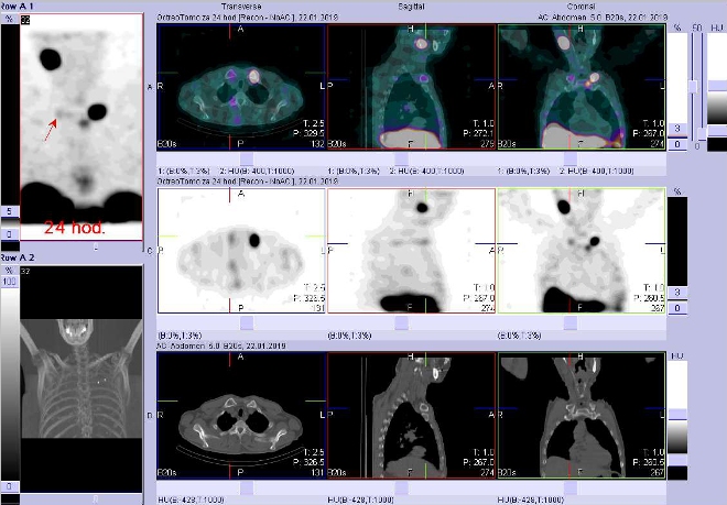 Obr. č. 5: Fúze obrazů SPECT a CT. Vyšetření 24 hod. po aplikaci radioindikátoru. Zaměřeno na ložisko v pravé klíční kosti v blízkosti sternoklavikulárního skloubení.