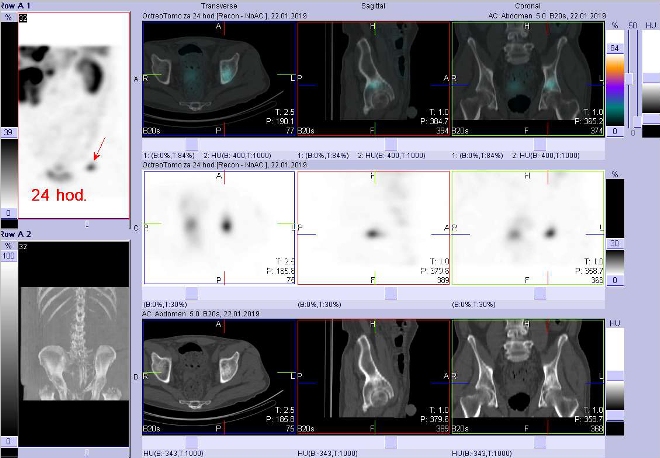 Obr. č. 9: Fúze obrazů SPECT a CT. Vyšetření 24 hod. po aplikaci radioindikátoru. Zaměřeno na ložisko v kosti kyčelní vlevo nad acetabulem.