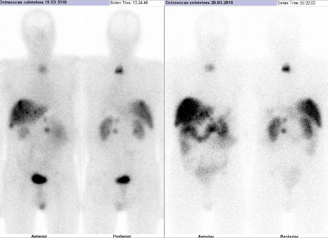 Obr.č. 1: Celotělová scintigrafie v přední a zadní projekci 4 (vlevo) a 24 hod. (vpravo) po aplikaci OctreoScanu.