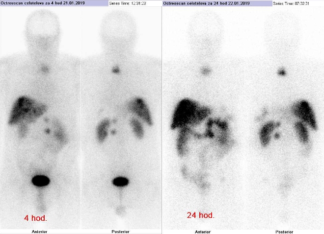 Obr. č. 2: Celotělová scintigrafie v přední a zadní projekci 4 (vlevo) a 24 hod. (vpravo) po aplikaci OctreoScanu.