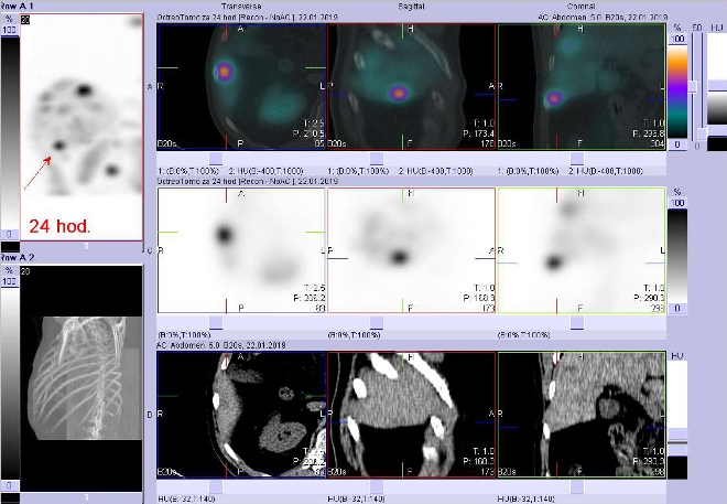 Obr. č. 5: Fúze SPECT/CT 24 hod. po aplikaci OctreoScanu. Zaměřeno na ložisko v kaudální části pravého jaterního laloku.