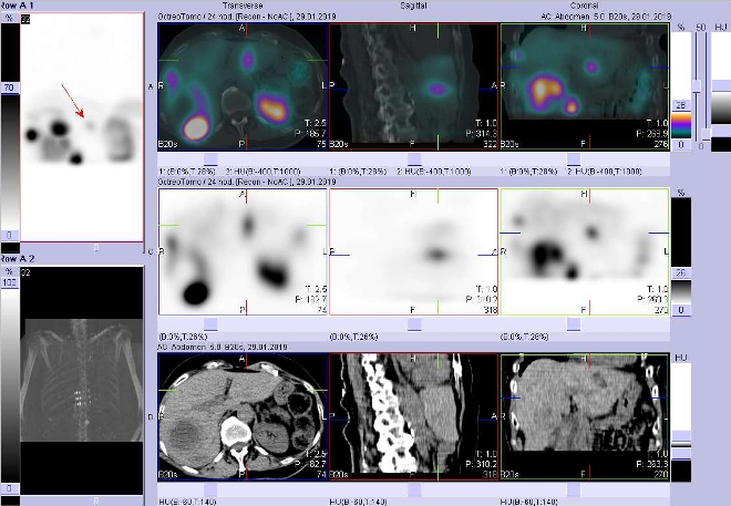 Obr. č. 10: Fúze obrazů SPECT a CT. Zaměřeno na ložisko v levém jaterním laloku. Vyšetření 24 hod. po aplikaci radioindikátoru.
