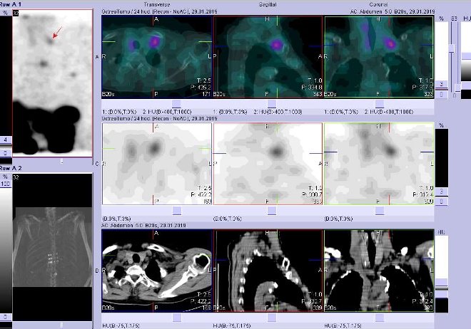 Obr. č. 13: Fúze obrazů SPECT a CT. Zaměřeno na uzlinu supraklavikulárně vlevo. Vyšetření 24 hod. po aplikaci radioindikátoru.