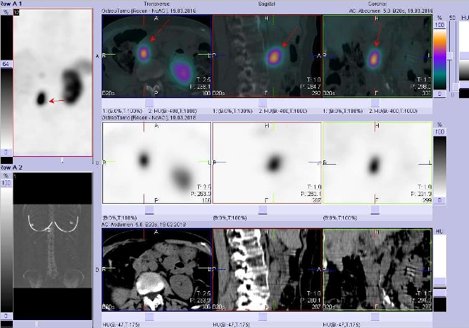 Obr.3: Fúze obrazů SPECT a CT. Zaměřeno na ložisko paraaortálně vpravo v uzlině v úrovni L2/L3. Vyšetření 4 hod. po aplikaci radioindikátoru.