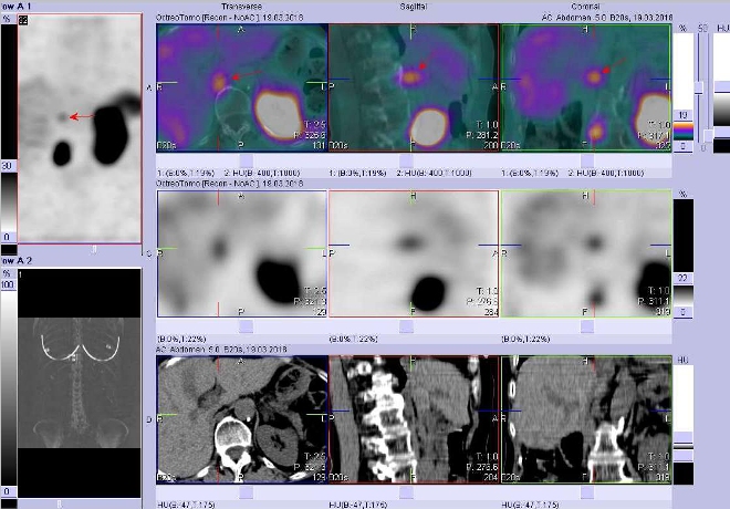 Obr. č. 4: Fúze obrazů SPECT a CT. Zaměřeno na ložisko v uzlině paravertebrálně vpravo ve výši Th12/L1. Vyšetření 4 hod. po aplikaci radioindikátoru.