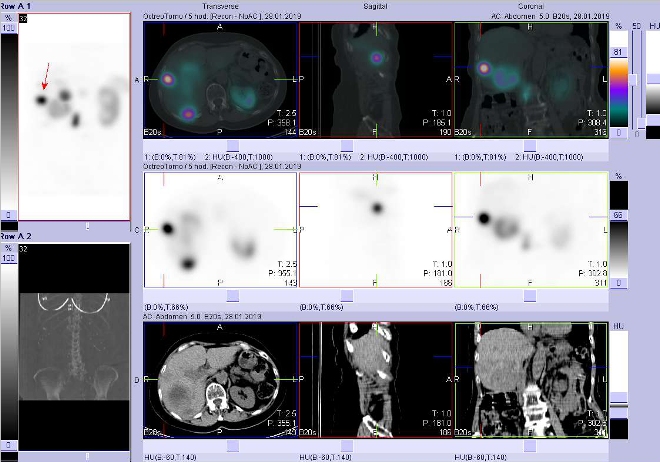 Obr. č. 6: Fúze obrazů SPECT a CT. Zaměřeno na ložisko v laterální části pravého jaterního laloku. Vyšetření 4 hod. po aplikaci radioindikátoru.