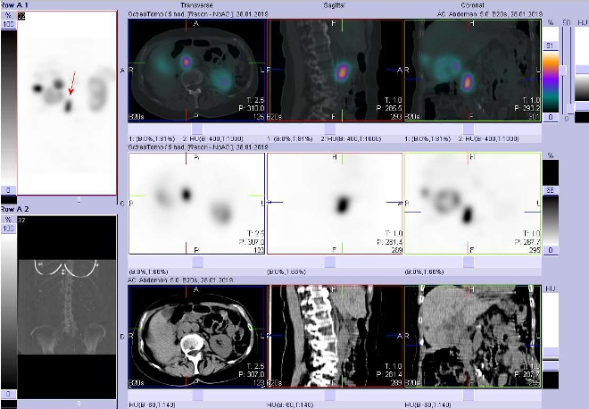 Obr. č. 7: Fúze obrazů SPECT a CT. Zaměřeno na ložisko paraaortálně vpravo v uzlině v úrovni L2/L3. Vyšetření 4 hod. po aplikaci radioindikátoru.