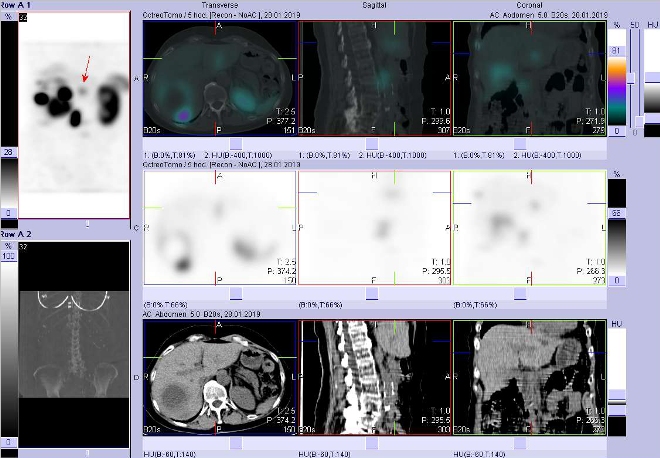 Obr. č. 8: Fúze obrazů SPECT a CT. Zaměřeno na ložisko v levém jaterním laloku. Vyšetření 4 hod. po aplikaci radioindikátoru.
