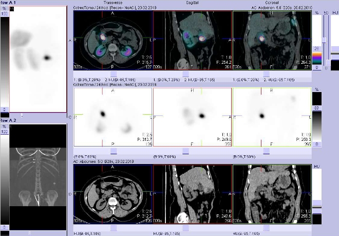 Obr. č. 1: Fúze obrazů SPECT a CT. Vyšetření 4 hod. po aplikaci radioindikátoru. Zaměřeno na ložisko mezi pankreatem a duodenem.