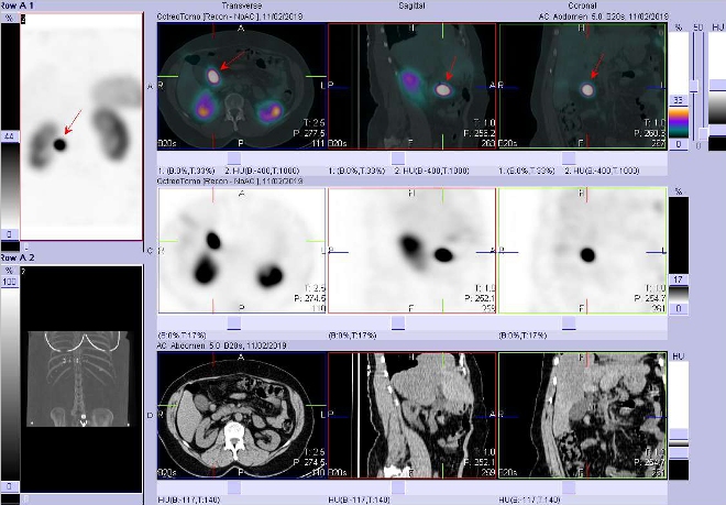 Obr. č. 3: Fúze obrazů SPECT a CT. Vyšetření 4  hod. po aplikaci radioindikátoru. Zaměřeno na ložisko mezi pankreatem a duodenem.