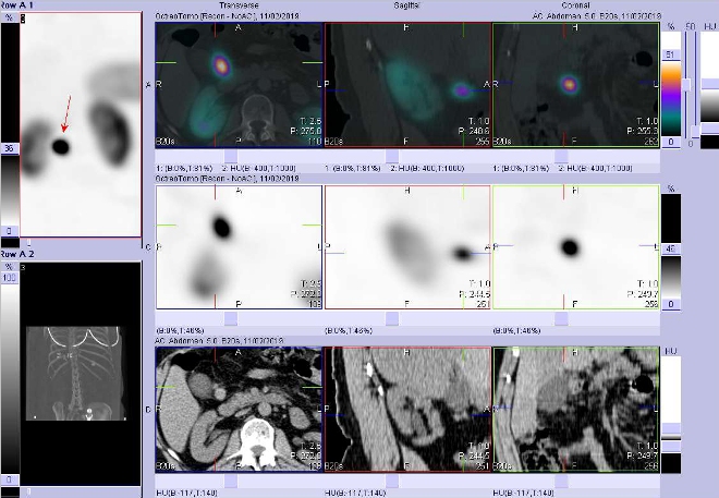 Obr. č. 4: Fúze obrazů SPECT a CT. Vyšetření 4  hod. po aplikaci radioindikátoru. Zaměřeno na ložisko mezi pankreatem a duodenem.