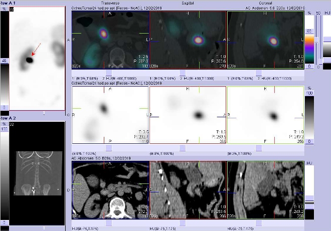 Obr. č. 5: Fúze obrazů SPECT a CT. Vyšetření 24 hod. po aplikaci radioindikátoru. Zaměřeno na ložisko mezi pankreatem a duodenem.