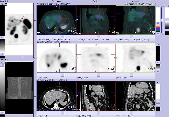 Obr. č. 5: Fúze obrazů SPECT a CT. Vyšetření 4 hod. po aplikaci radioindikátoru. Zaměřeno na ložisko v levém jaterním laloku.