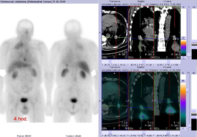 Obr. č. 1: Celotělová scintigrafie v přední a zadní projekci a fúze SPECT/CT hrudníku a proximální části břicha 4 hod. po aplikaci OctreoScanu. Zaměřeno na ložisko těsně pod levou bránicí v blízkosti levé nadledviny.