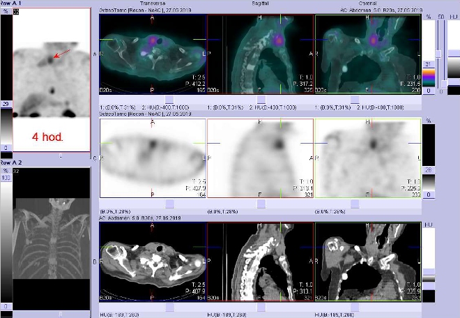 Obr. č. 2: Fúze SPECT/CT krku a hrudníku 4 hod. po aplikaci OctreoScanu. Zaměřeno na ložisko v pravém laloku štítné žlázy.