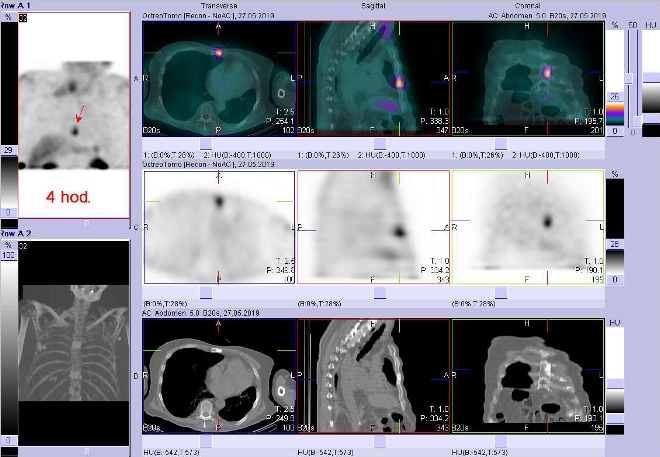 Obr. č. 4: Fúze SPECT/CT hrudníku a proximální části břicha 4 hod. po aplikaci OctreoScanu. Zaměřeno na ložisko ve sternu.