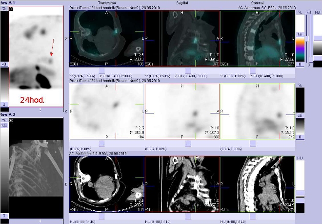 Obr. č. 6: Fúze SPECT/CT hrudníku a proximální části břicha 24 hod. po aplikaci OctreoScanu. Zaměřeno na ložisko ve sternu.