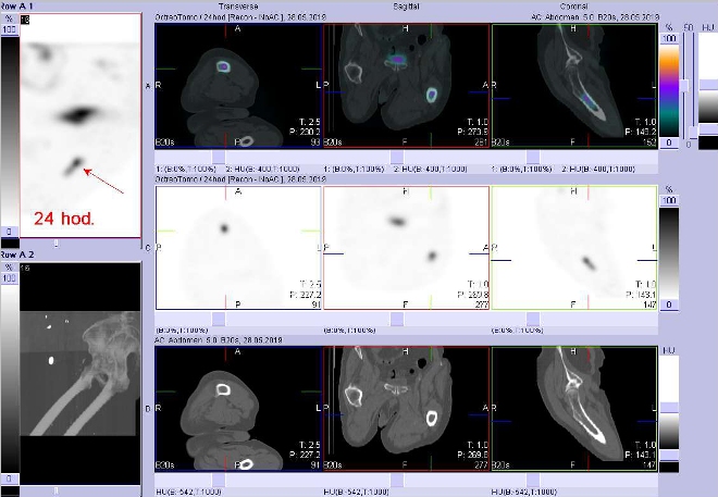 Obr. č. 9: Fúze SPECT/CT stehenních kostí 24 hod. po aplikaci OctreoScanu. Zaměřeno na ložisko v levé stehenní kosti.