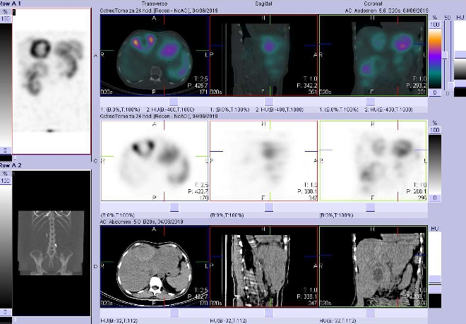 Obr. č. 10: Fúze obrazů SPECT a CT. Vyšetření 24 hod. po aplikaci radiofarmaka. Zaměřeno na ložisko ve ventrokraniální části levého jaterního laloku.