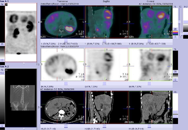 Obr. č. 5: Fúze obrazů SPECT a CT. Vyšetření 4 hod. po aplikaci radiofarmaka. Zaměřeno na ložisko s nekrózou  ve ventrokaudální části pravého jaterního laloku.