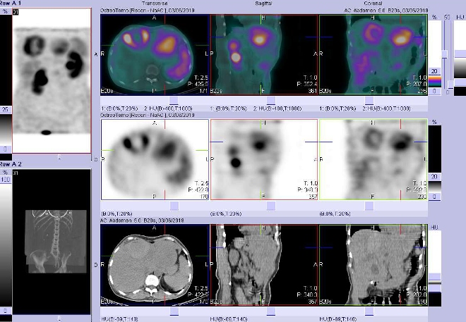 Obr. č. 7: Fúze obrazů SPECT a CT. Vyšetření 4 hod. po aplikaci radiofarmaka. Zaměřeno na ložisko s  ve ventrokraniální části levého jaterního laloku.