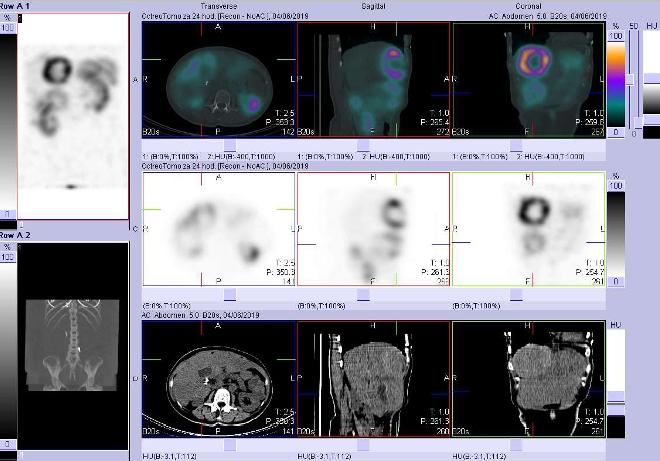 Obr. č. 9: Fúze obrazů SPECT a CT. Vyšetření 24 hod. po aplikaci radiofarmaka. Zaměřeno na ložisko s nekrózou  ve ventrokaudální části pravého jaterního laloku.