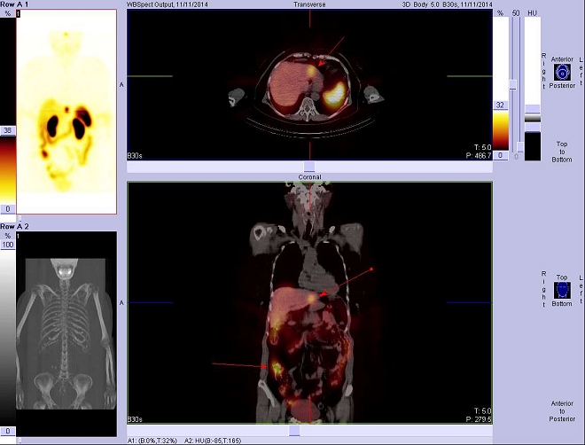 Obr. č. 3: SPECT/CT hrudníku a břicha 2. den snímání.