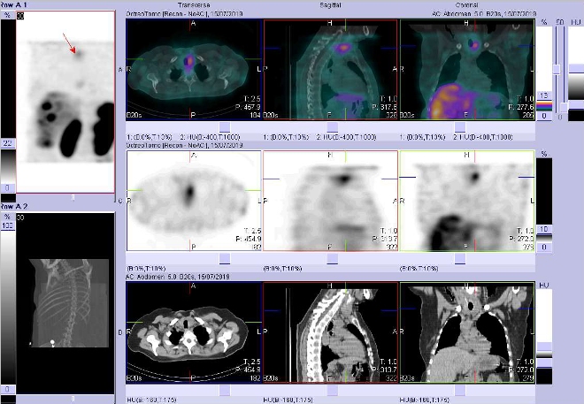 Obr. č. 4: Fúze SPECT/CT hrudníku a proximální části břicha 4 hod. po aplikaci OctreoScanu. Zaměřeno na ložisko v levém laloku štítné žlázy.