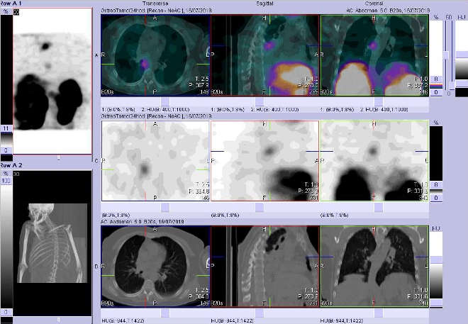 Obr. č. 5: Fúze SPECT/CT krku, hrudníku a proximální části břicha 24 hod. po aplikaci OctreoScanu. Zaměřeno na ložisko v mediastinu vpravo.