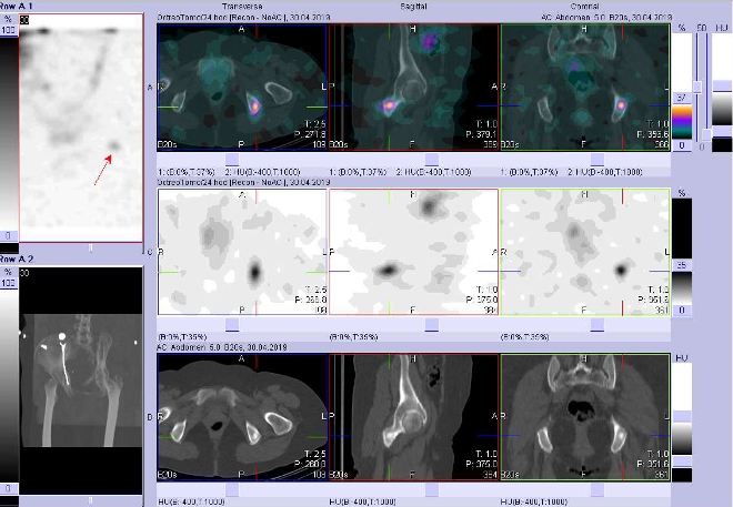Obr. č. 10: Fúze obrazů SPECT a CT.  Zaměřeno na ložisko v  levé kosti sedací. Vyšetření 24 hod. po aplikaci OctreoScanu.