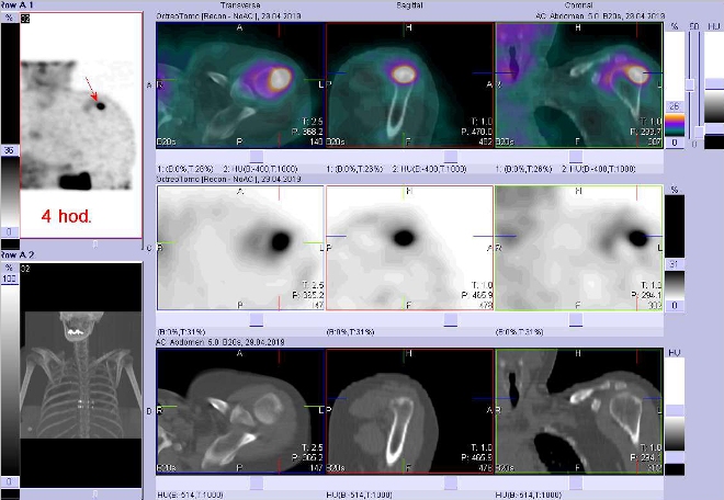 Obr. č. 2: Fúze obrazů SPECT a CT.  Zaměřeno na ložisko v proximální části levého humeru. Vyšetření 4 hod. po aplikaci OctreoScanu.