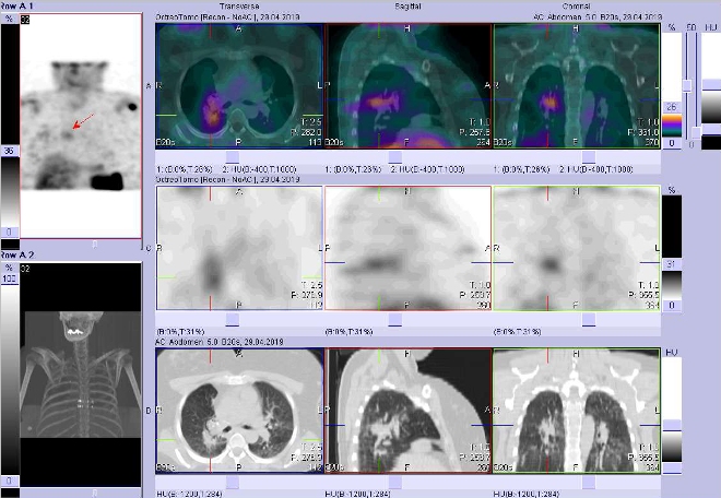 Obr. č. 3: Fúze obrazů SPECT a CT. Zaměřeno na ložisko v pravé plíci dorzálně. Vyšetření 4 hod. po aplikaci OctreoScanu.