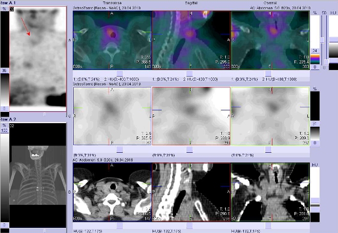 Obr. č. 4: Fúze obrazů SPECT a CT. Zaměřeno na ložisko v pravém laloku štítné žlázy. Vyšetření 4 hod. po aplikaci OctreoScanu.