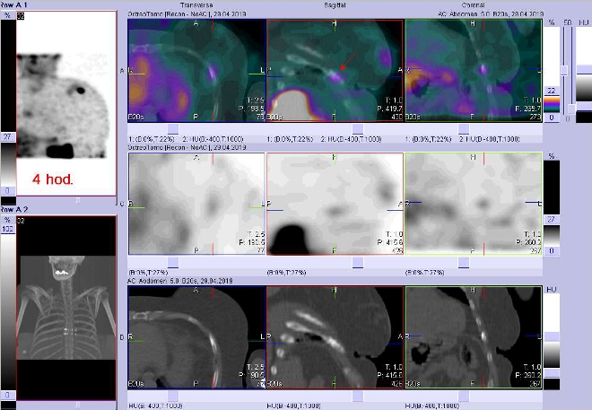 Obr. č. 5: Fúze obrazů SPECT a CT. Zaměřeno na ložisko v jednom levostranném žebru ventrolaterálně. Vyšetření 4 hod. po aplikaci OctreoScanu.