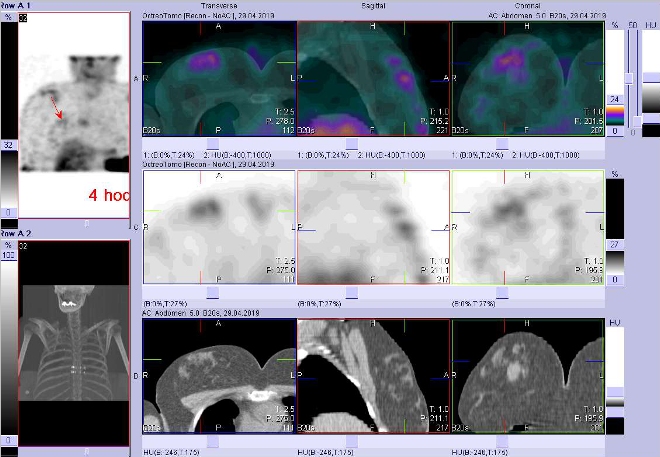 Obr. č. 6: Fúze obrazů SPECT a CT.  Zaměřeno na ložisko v pravém prsu. Na ldCT několik hyperdenzních ložisek. Vyšetření 4 hod. po aplikaci OctreoScanu.