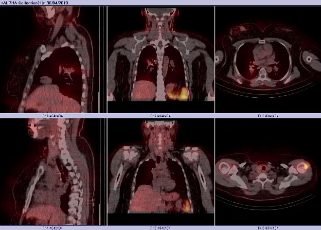 Obr. č. 8: Fúze obrazů SPECT a CT.  Zaměřeno na ložisko v pravé plíci a v levé pažní kosti. Vyšetření 24 hod. po aplikaci OctreoScanu.