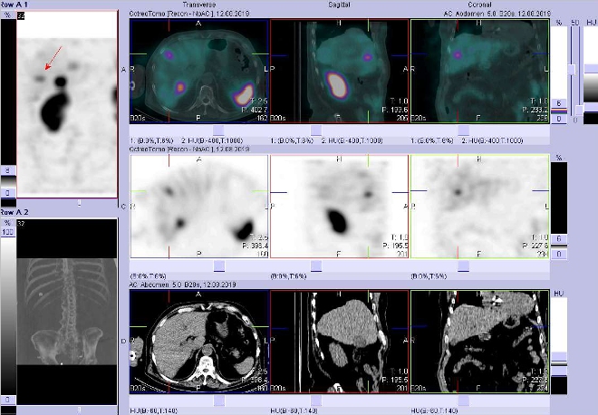 Obr. č. 3: Fúze obrazů SPECT a CT – vyšetření břicha a pánve 4 hod. po aplikaci radiofarmaka. Zaměřeno na ložisko ve ventrolaterální části pravého jaterního laloku.