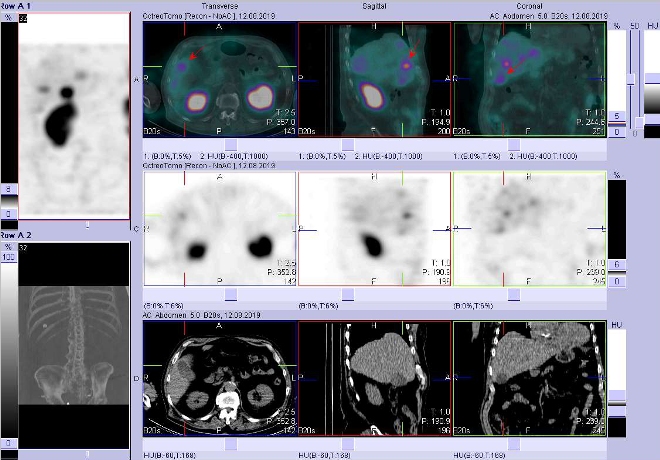 Obr. č. 4: Fúze obrazů SPECT a CT – vyšetření 4 hod. po aplikaci radiofarmaka. Zaměřeno na žlučník.