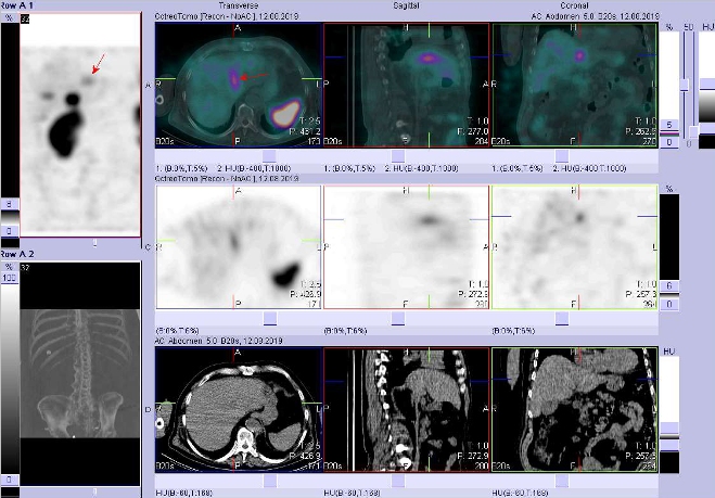Obr. č. 5:Fúze obrazů SPECT a CT – vyšetření břicha a pánve 4 hod. po aplikaci radiofarmaka. Zaměřeno na ložisko na rozhraní obou laloků.